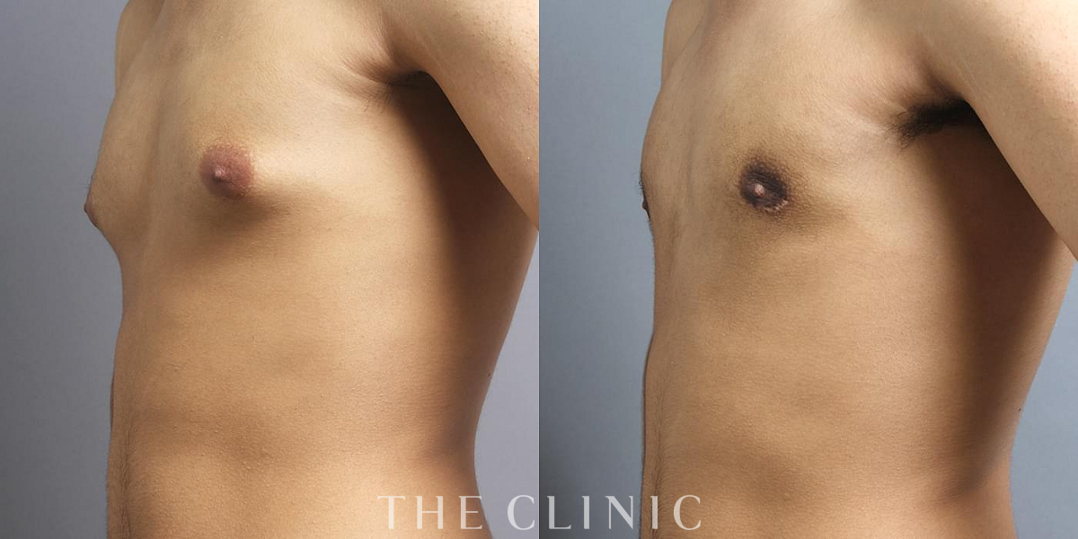 女性化乳房治療(男性の胸の膨らみ改善)の術前/術後