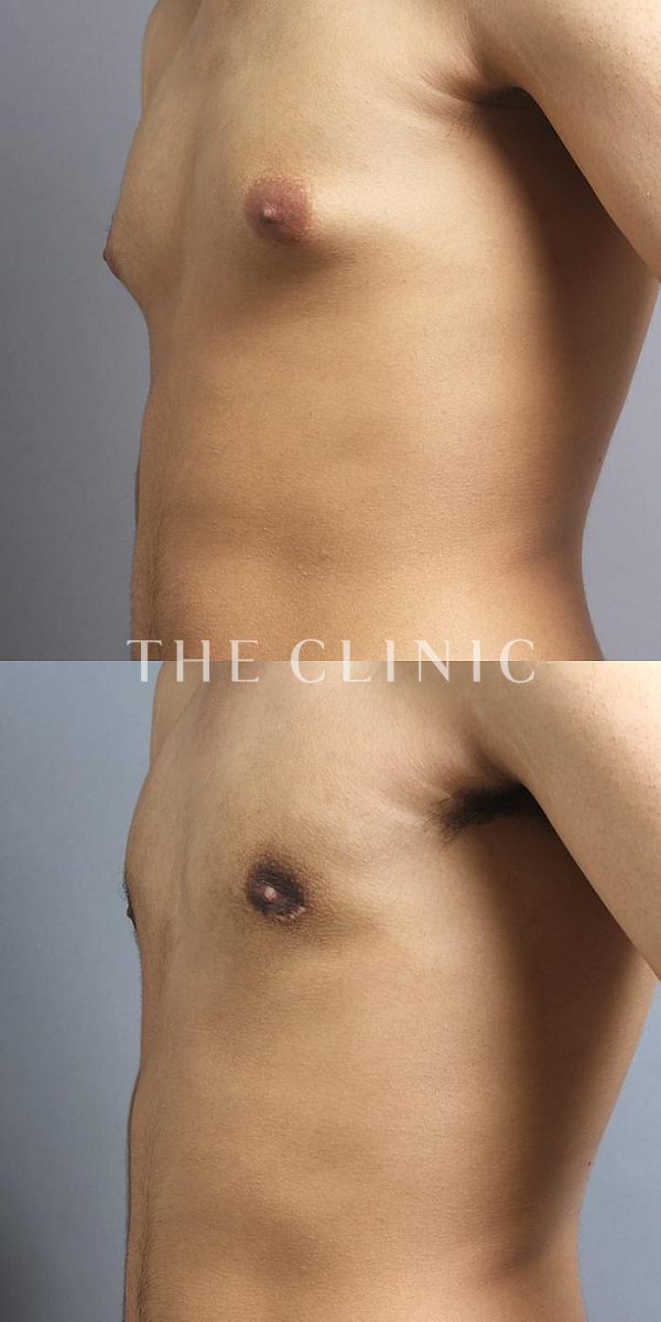 女性化乳房・真性＋偽性女性化乳房の女性化乳房治療(男性の胸の膨らみ改善)（20歳男性）の術前・術後写真