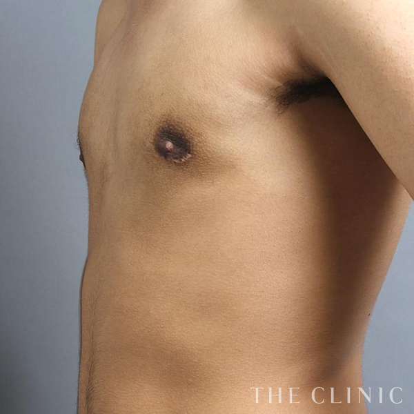 女性化乳房・真性＋偽性女性化乳房の女性化乳房治療(男性の胸の膨らみ改善)（20歳男性）の術後写真