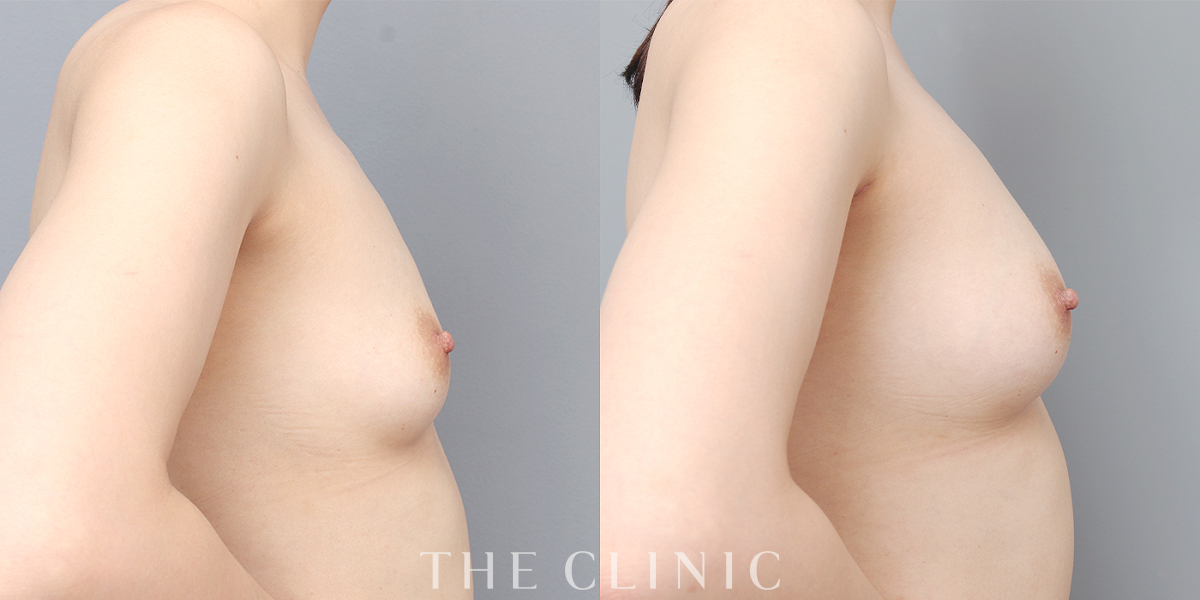 コンデンスリッチ豊胸の術前／術後