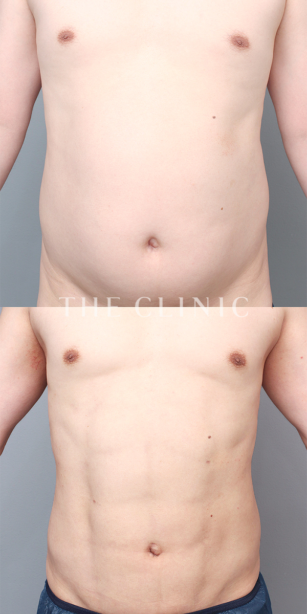 SIX PACK ６つに割れた腹筋のベイザー4D(男性のシックスパック脂肪吸引)（37歳男性）の術前・術後写真