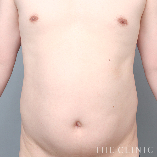 SIX PACK ６つに割れた腹筋のベイザー4D(男性のシックスパック脂肪吸引)（37歳男性）の術前写真