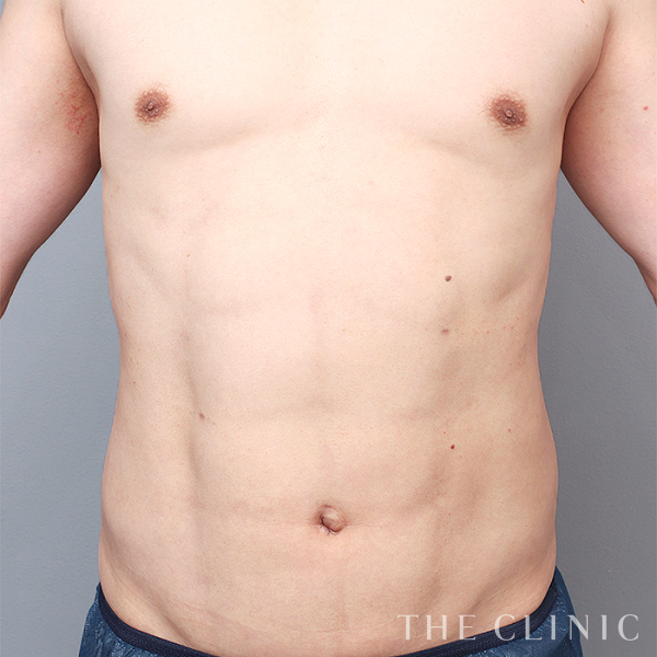 SIX PACK ６つに割れた腹筋のベイザー4D(男性のシックスパック脂肪吸引)（37歳男性）の術後写真