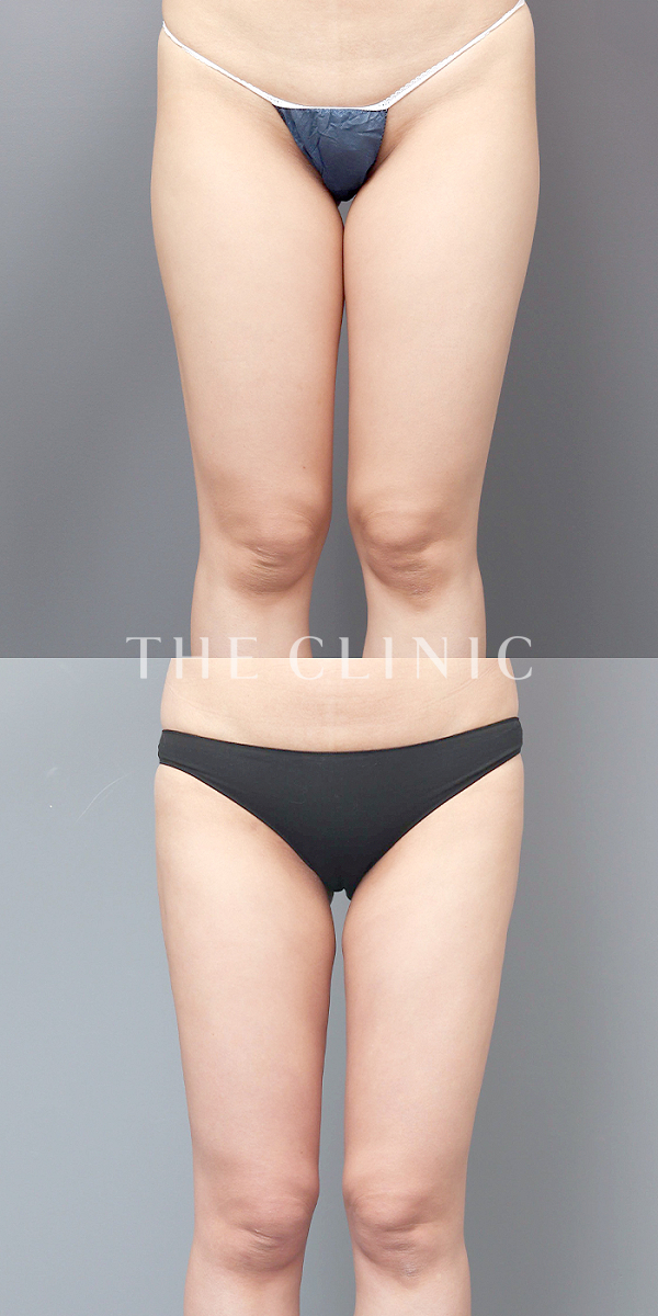 太もものベイザー脂肪吸引（33歳女性）の術前・術後写真
