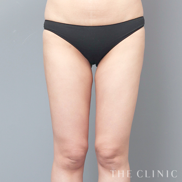 太もものベイザー脂肪吸引（33歳女性）の術後写真