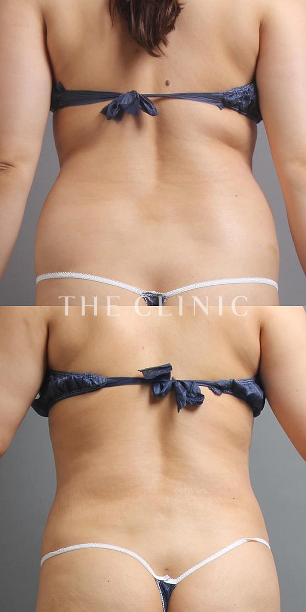 背中のベイザー脂肪吸引（40歳女性）の術前・術後写真