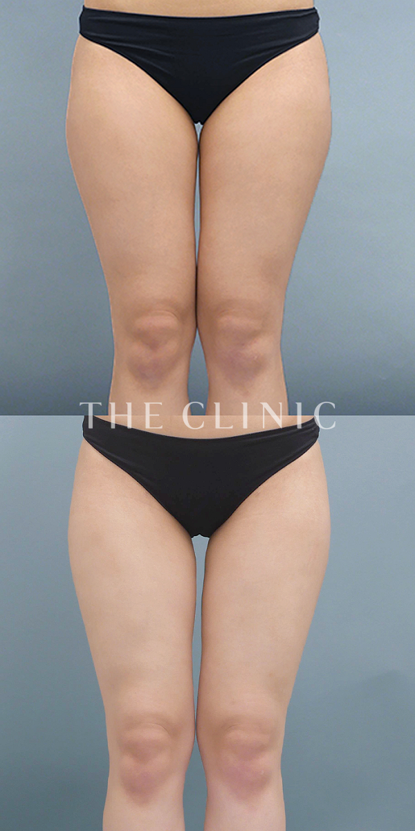 太もものベイザー脂肪吸引（20歳女性）の術前・術後写真