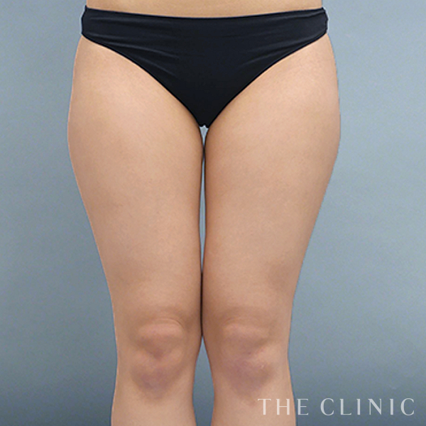 太もものベイザー脂肪吸引（20歳女性）の術前写真