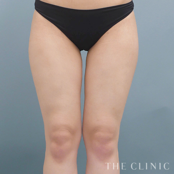 太もものベイザー脂肪吸引（20歳女性）の術後写真