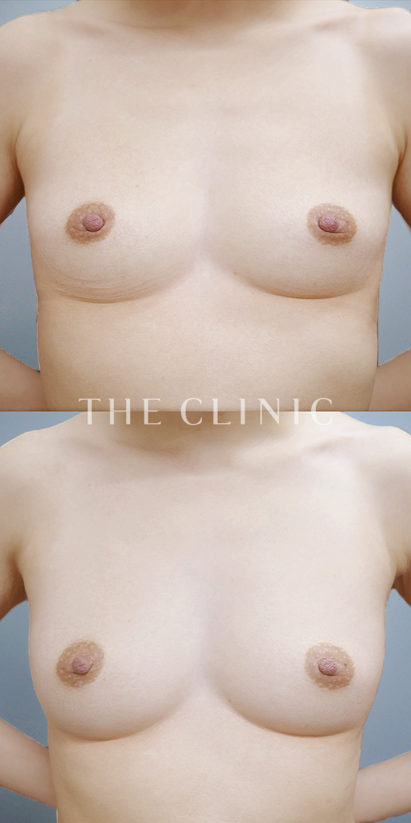 ボリュームアップのコンデンスリッチ豊胸（29歳女性）の術前・術後写真