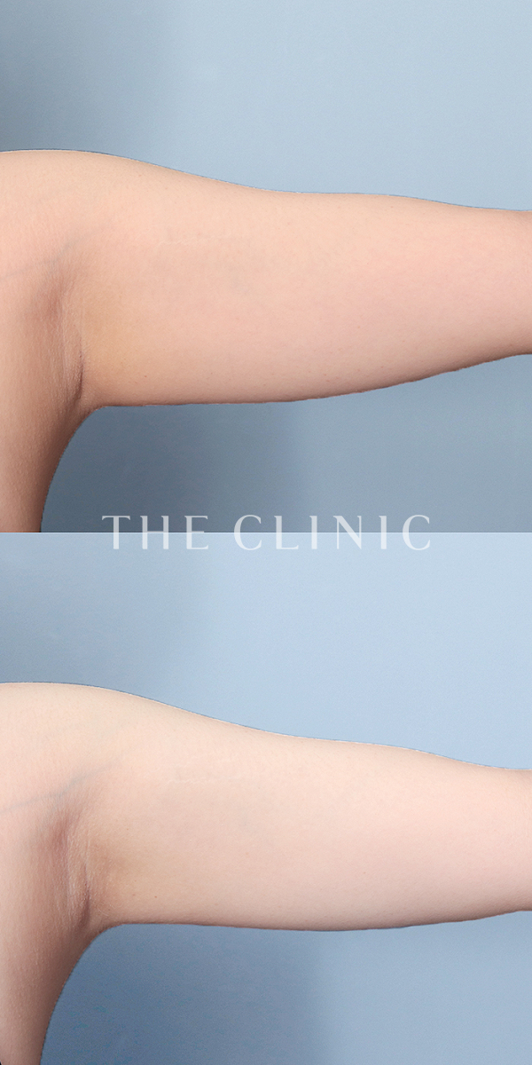 二の腕・腕の付け根のベイザー脂肪吸引（21歳女性）の術前・術後写真