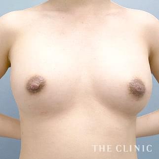 【THE CLINIC 症例画像】No.1413_2_ボリュームアップ_エクソソーム豊胸(執刀医：木村 圭吾)