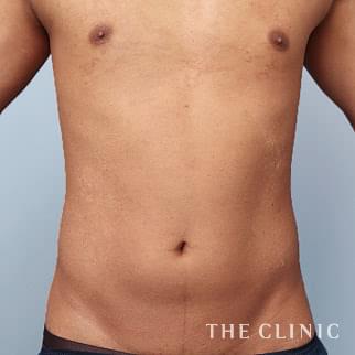 腹部／SIX PACK ６つに割れた腹筋のベイザー4D(男性のシックスパック脂肪吸引)のモニター（20代）術前症例画像