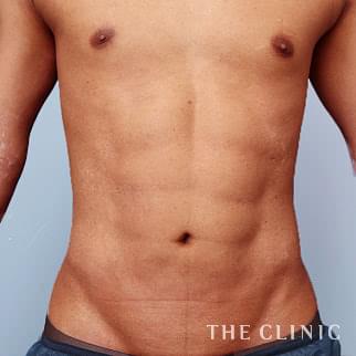 腹部/SIX PACK 6つに割れた腹筋のベイザー4D(男性のシックスパック脂肪吸引)のモニター(20代)術後症例画像