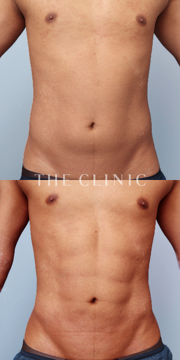 腹部・SIX PACK ６つに割れた腹筋のベイザー4D(男性のシックスパック脂肪吸引)（27歳男性）の術前・術後写真