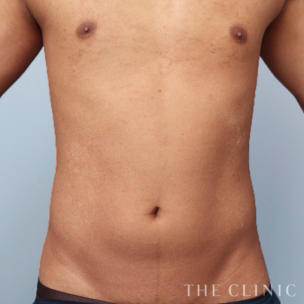 THE CLINIC ザクリニック　脂肪吸引　圧迫着　お腹背中腰S美品 腹部・SIX PACK 6つに割れた腹筋のベイザー4D(男性のシックス