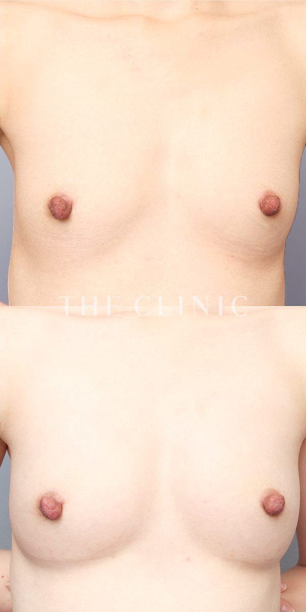 ボリュームアップのコンデンスリッチ豊胸（35歳女性）の術前・術後写真