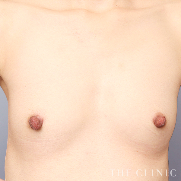 ボリュームアップのコンデンスリッチ豊胸（35歳女性）の術前写真