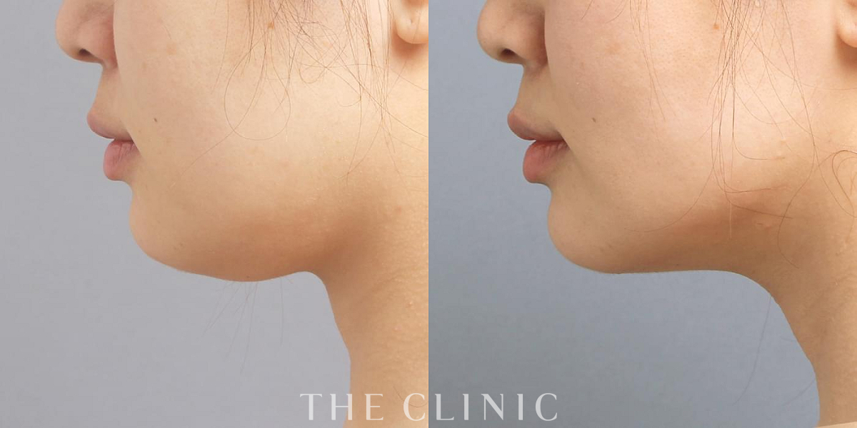 ベイザー脂肪吸引の術前/術後