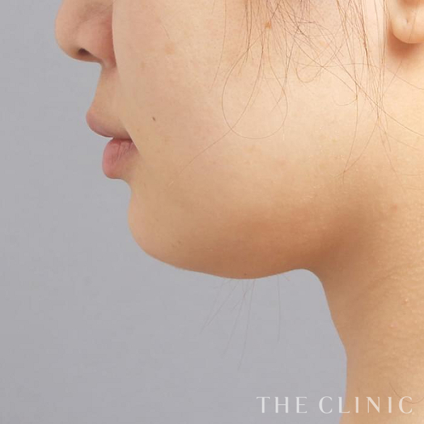 頰／顎のベイザー脂肪吸引（40歳女性）の術前写真