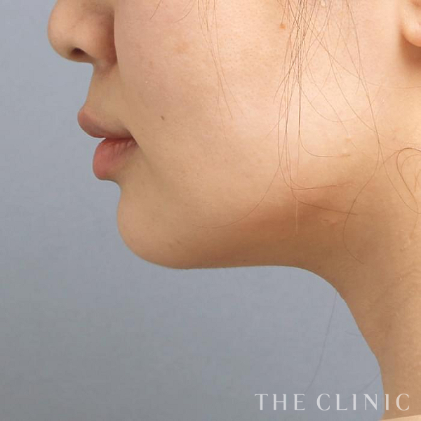 頰／顎のベイザー脂肪吸引（40歳女性）の術後写真