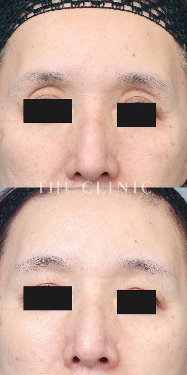 ボリュームアップ・目の上のくぼみのマイクロCRF注入(顔の脂肪注入)（56歳女性）の術前・術後写真