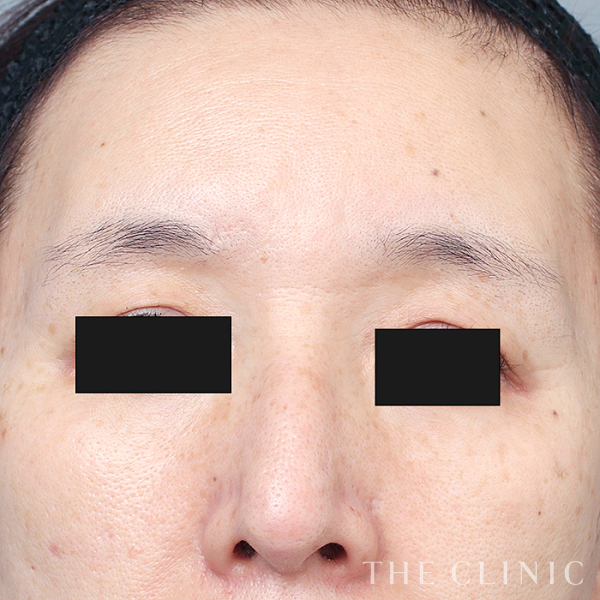 ボリュームアップ・目の上のくぼみのマイクロCRF注入(顔の脂肪注入)（56歳女性）の術後写真