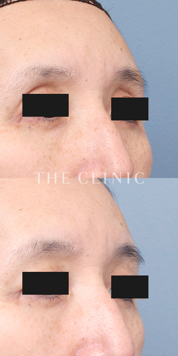 目の上のくぼみのマイクロCRF注入(顔の脂肪注入)（56歳女性）の術前・術後写真