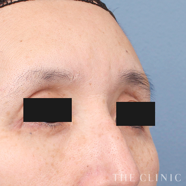 目の上のくぼみのマイクロCRF注入(顔の脂肪注入)（56歳女性）の術前写真