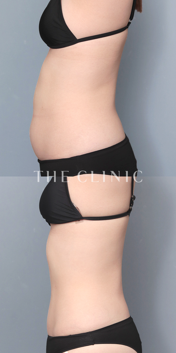 腹部のベイザー脂肪吸引（22歳女性）の術前・術後写真