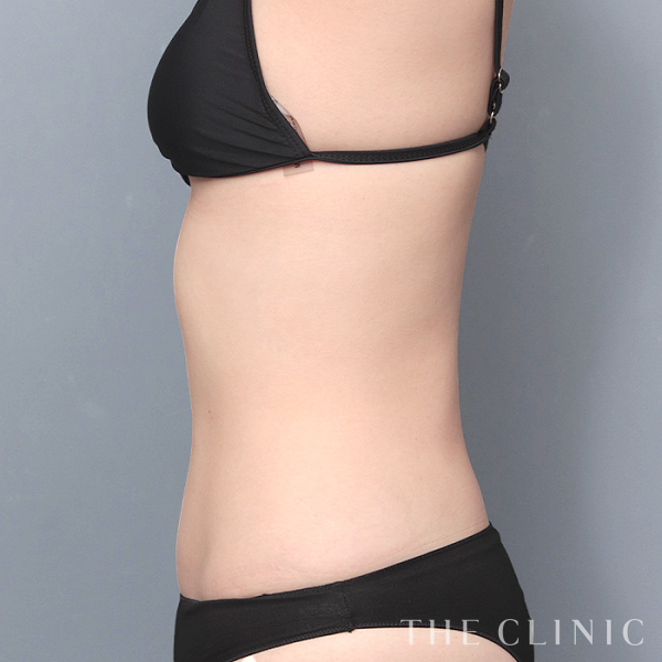 腹部のベイザー脂肪吸引（22歳女性）の術後写真