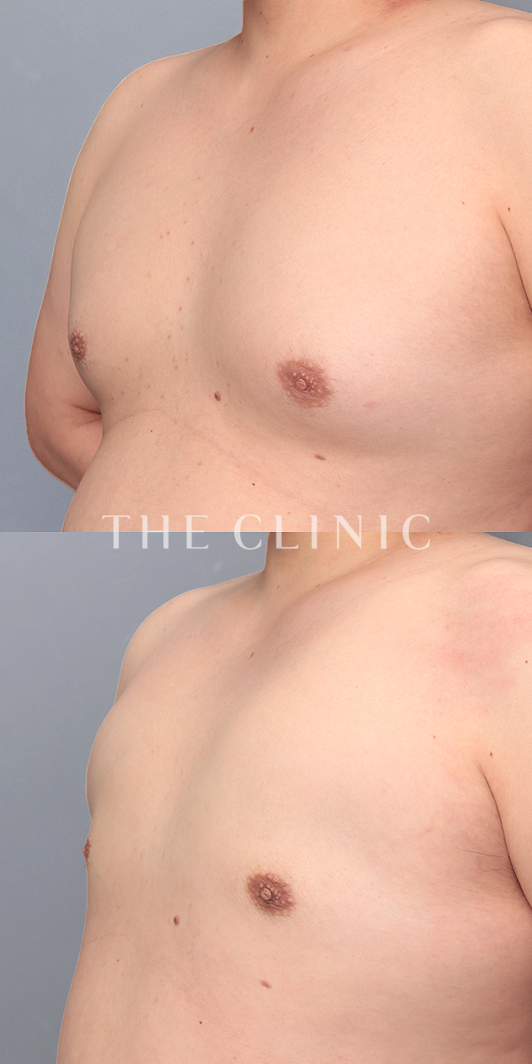 女性化乳房・偽性女性化乳房のベイザー脂肪吸引（35歳男性）の術前・術後写真