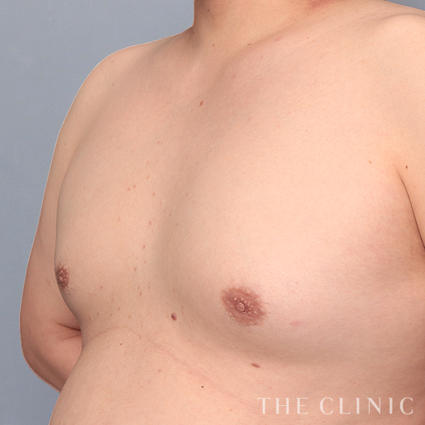 女性化乳房・偽性女性化乳房のベイザー脂肪吸引（35歳男性）の術前写真