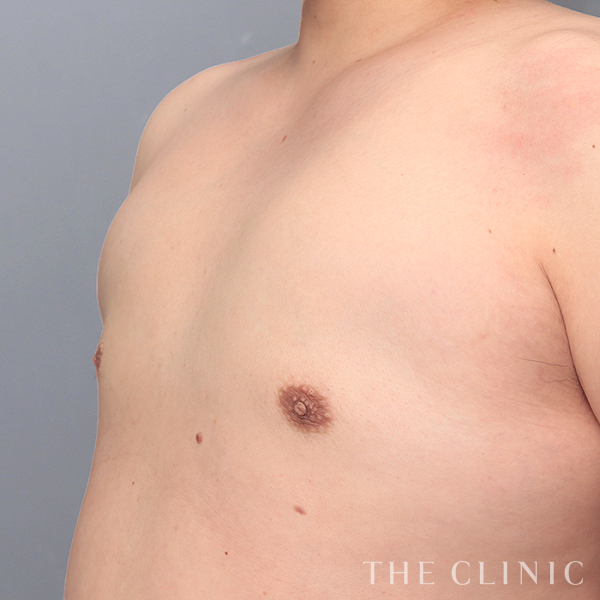 女性化乳房・偽性女性化乳房のベイザー脂肪吸引（35歳男性）の術後写真