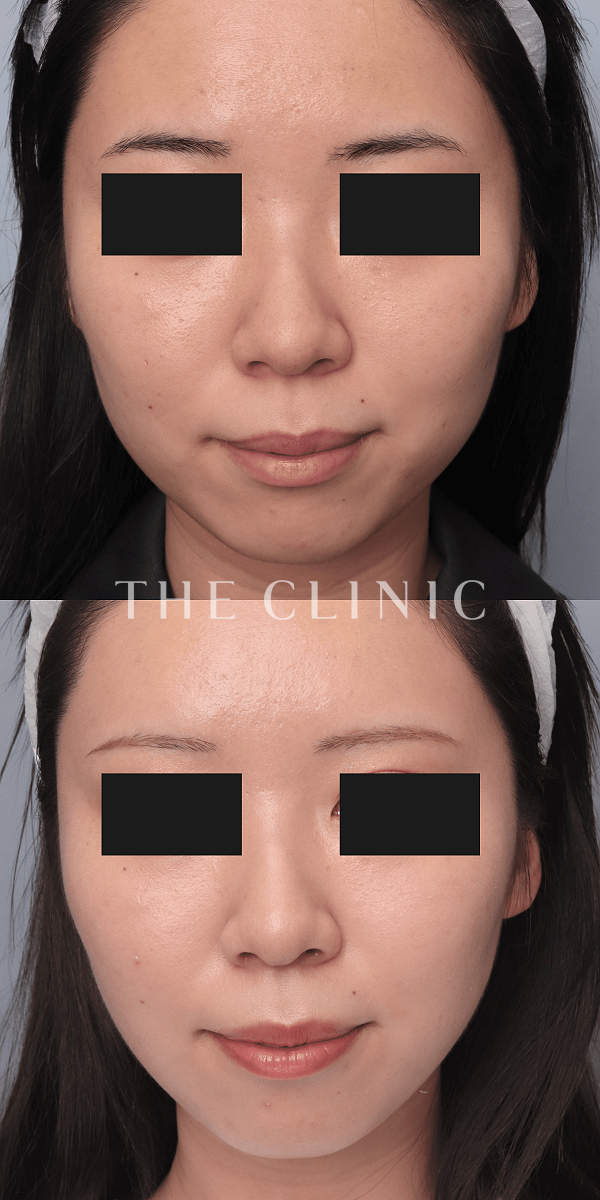頰／顎のベイザー脂肪吸引（21歳女性）の術前・術後写真