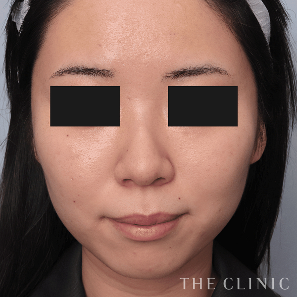 頰／顎のベイザー脂肪吸引（21歳女性）の術前写真