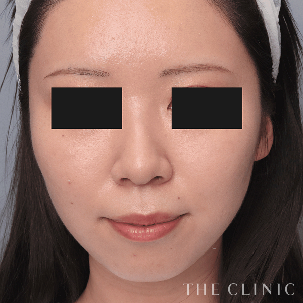 頰／顎のベイザー脂肪吸引（21歳女性）の術後写真