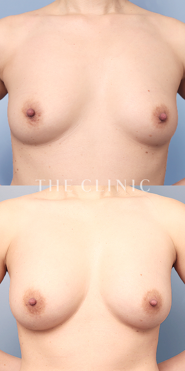 ボリュームアップのコンデンスリッチ豊胸（43歳女性）の術前・術後写真