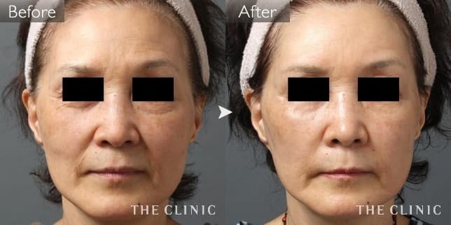 エイジング治療 法令線 症例写真