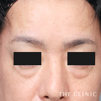 【THE CLINIC 症例画像】No.1430_1_目の下のクマ_コンデンスリッチフェイス(顔の脂肪注入)(執刀医:村田 八千穂)