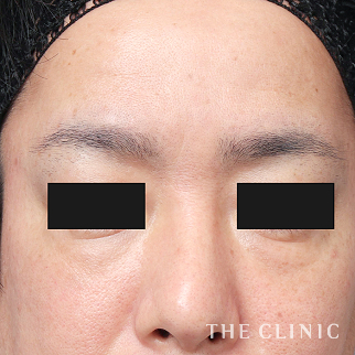 【THE CLINIC 症例画像】No.1430_2_目の下のクマ_コンデンスリッチフェイス(顔の脂肪注入)(執刀医:村田 八千穂)