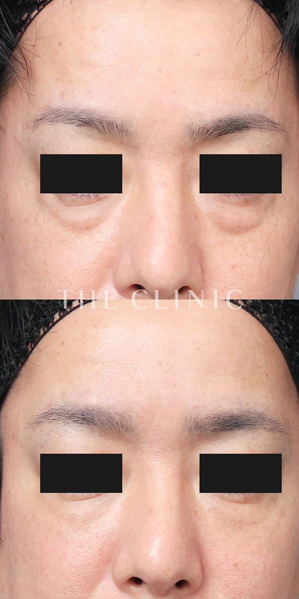 目の下のクマのコンデンスリッチフェイス(顔の脂肪注入)（42歳男性）の術前・術後写真