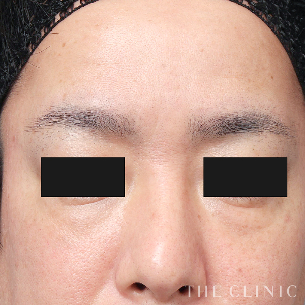 目の下のクマのコンデンスリッチフェイス(顔の脂肪注入)（42歳男性）の術後写真