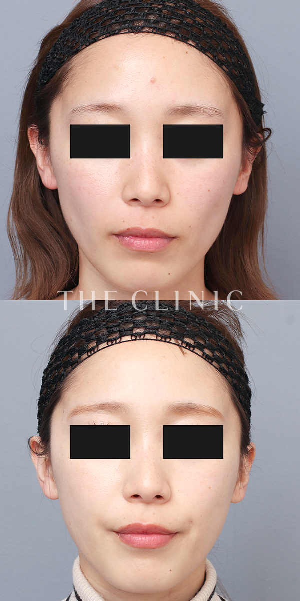 こけた頬のマイクロCRF注入(顔の脂肪注入)（26歳女性）の術前・術後写真