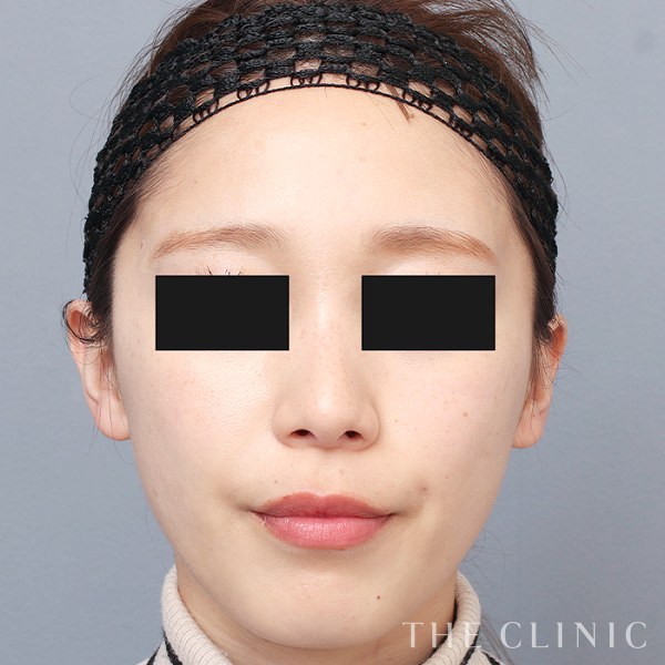 こけた頬のマイクロCRF注入(顔の脂肪注入)（26歳女性）の術後写真