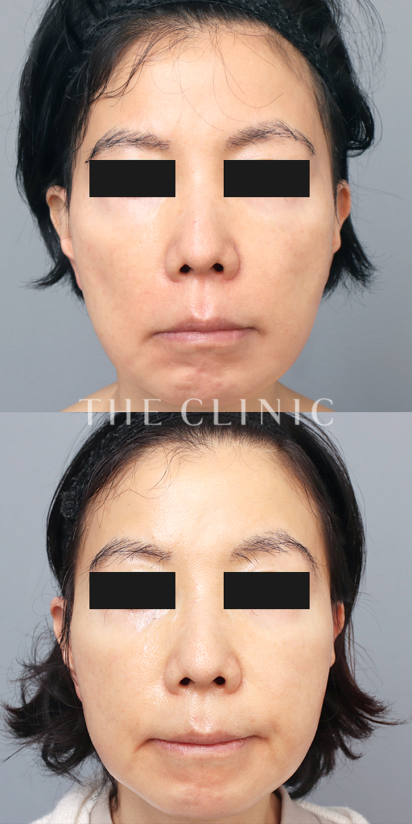 こけた頬のコンデンスリッチフェイス(顔の脂肪注入)（61歳女性）の術前・術後写真