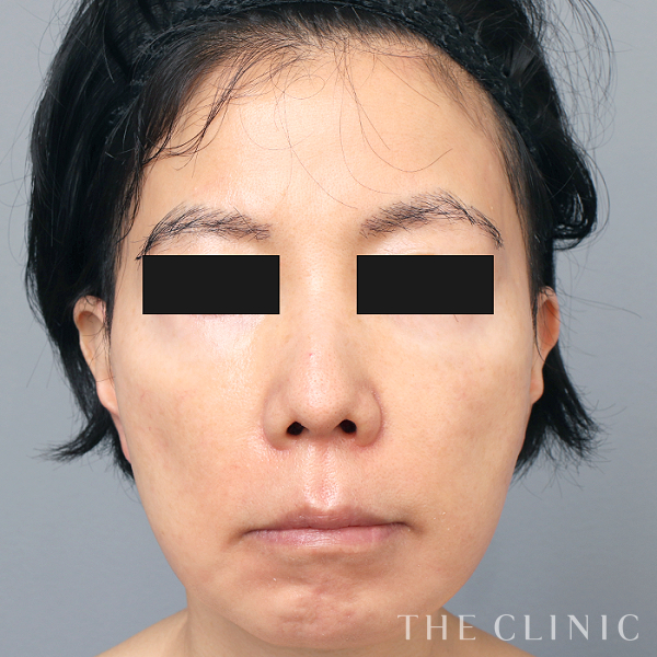 こけた頬のコンデンスリッチフェイス(顔の脂肪注入)（61歳女性）の術前写真