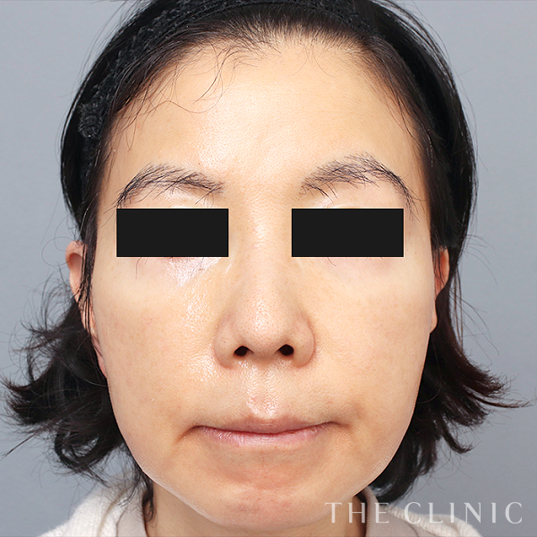 こけた頬のコンデンスリッチフェイス(顔の脂肪注入)（61歳女性）の術後写真