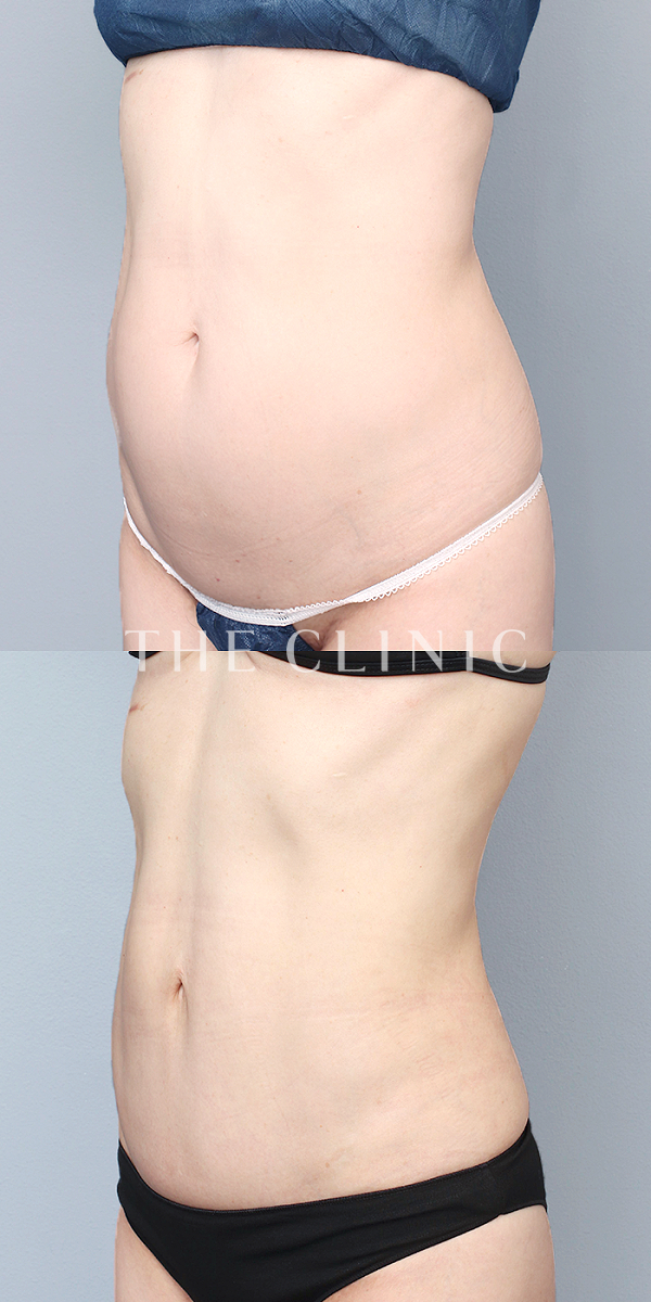 腹部のベイザー脂肪吸引（47歳女性）の術前・術後写真