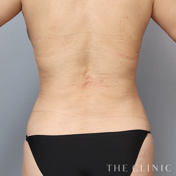 腰・ウエストのベイザー脂肪吸引（35歳女性）の術後写真
